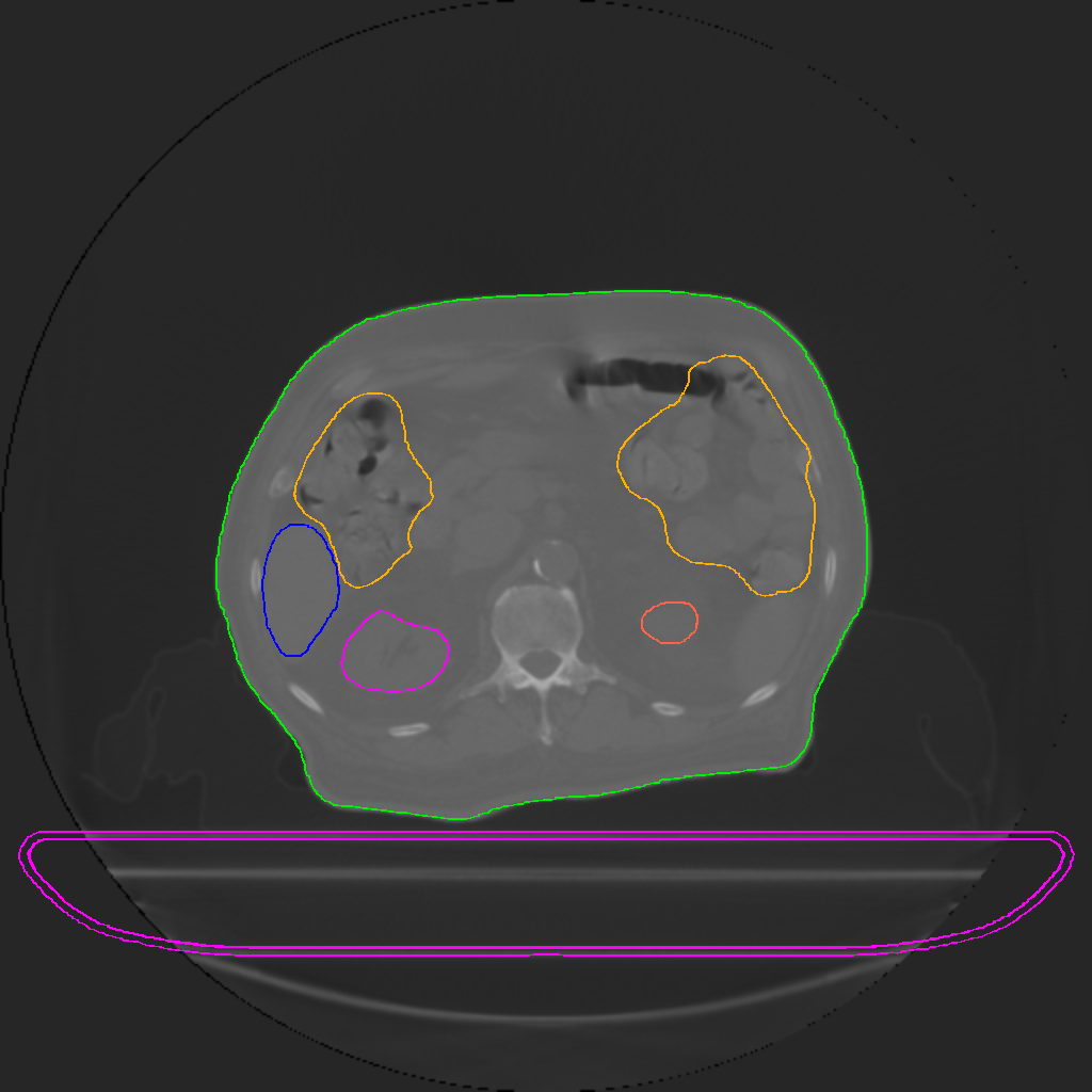 An anonymized CT slice with radiotherapy dose overlay