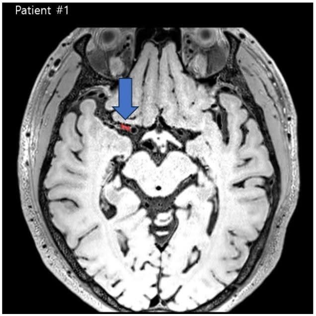 MRI example with a blue arrow pointing to a small red-marked vessel-wall target